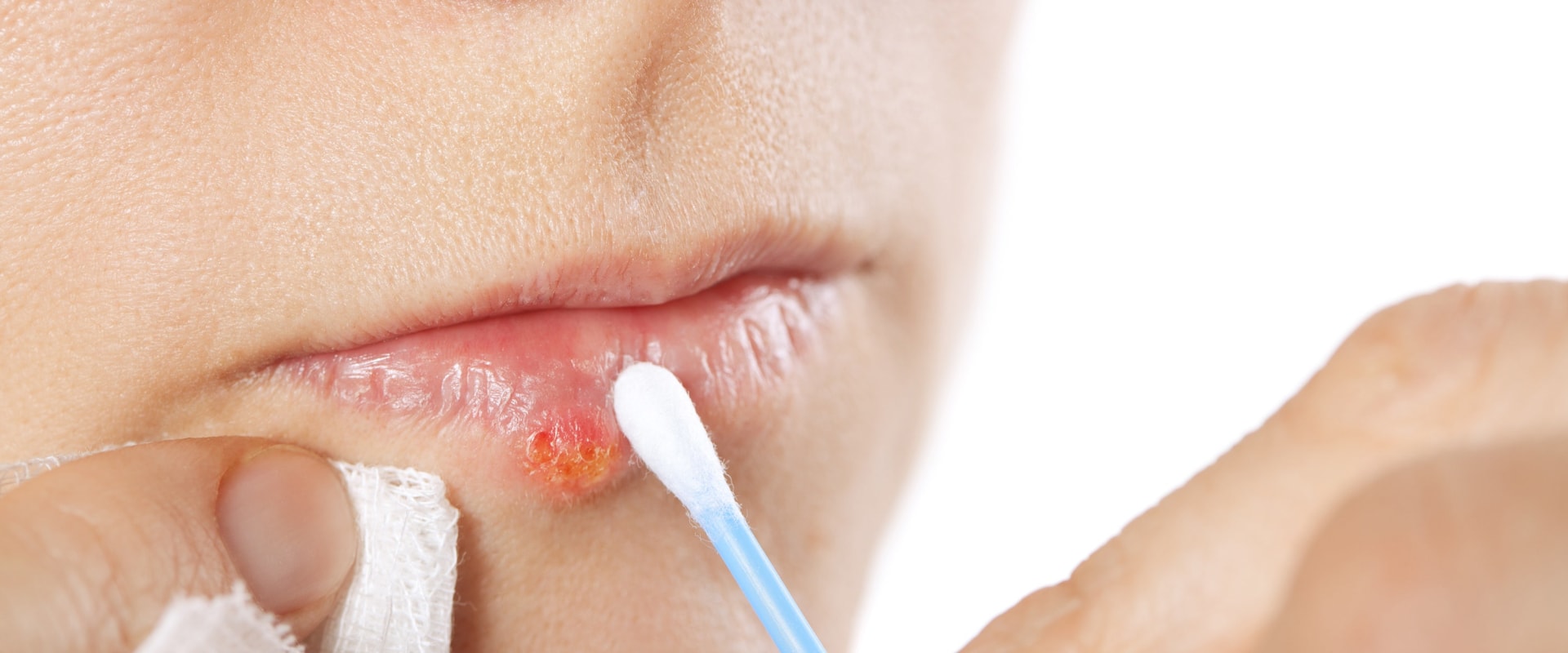 Topical Creams and Ointments: Treatments for Herpes Lips and Over-the-Counter Remedies