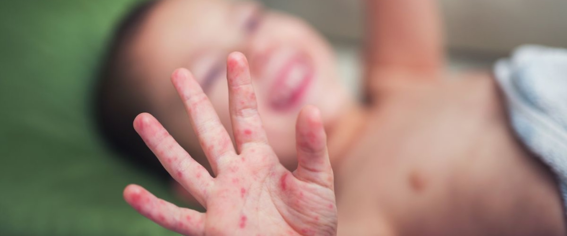 Coxsackievirus: An Overview