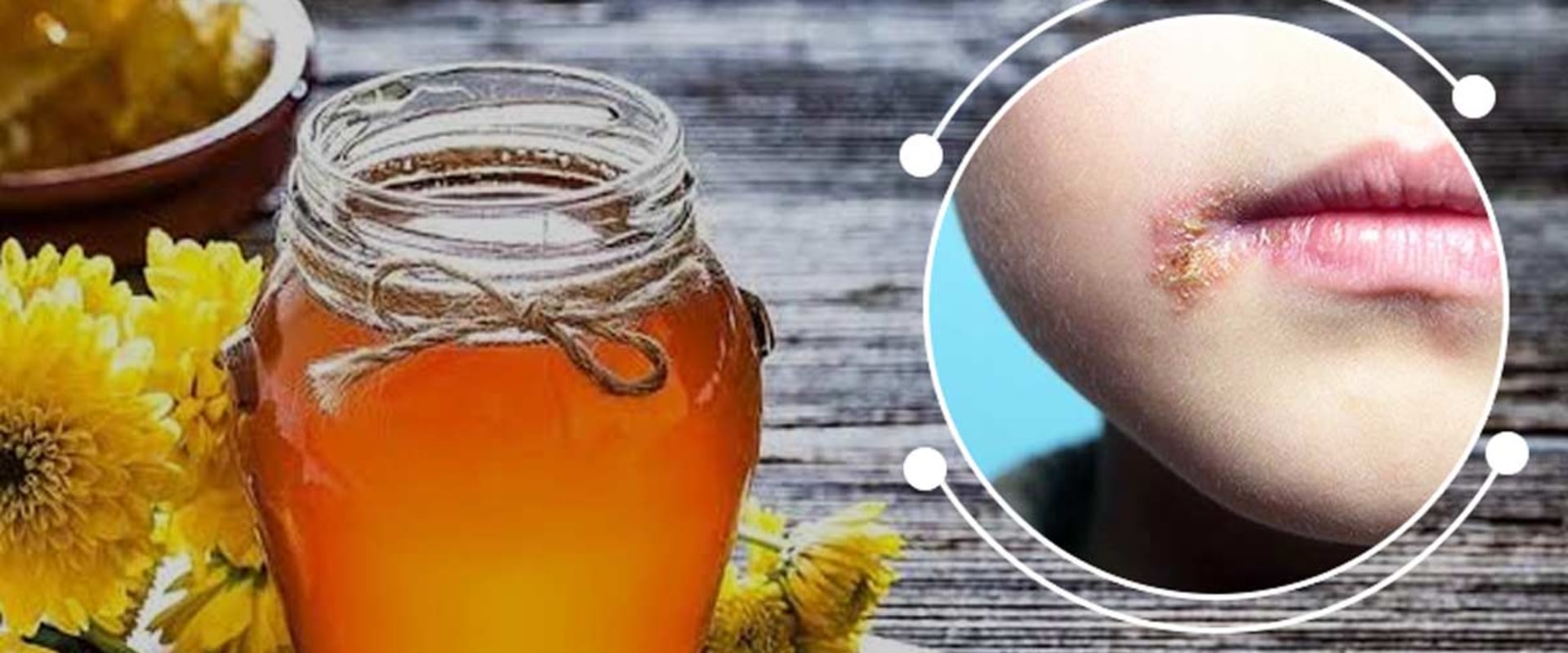 Honey and Lemon Juice Mixture: Home Remedies for Herpes Lips