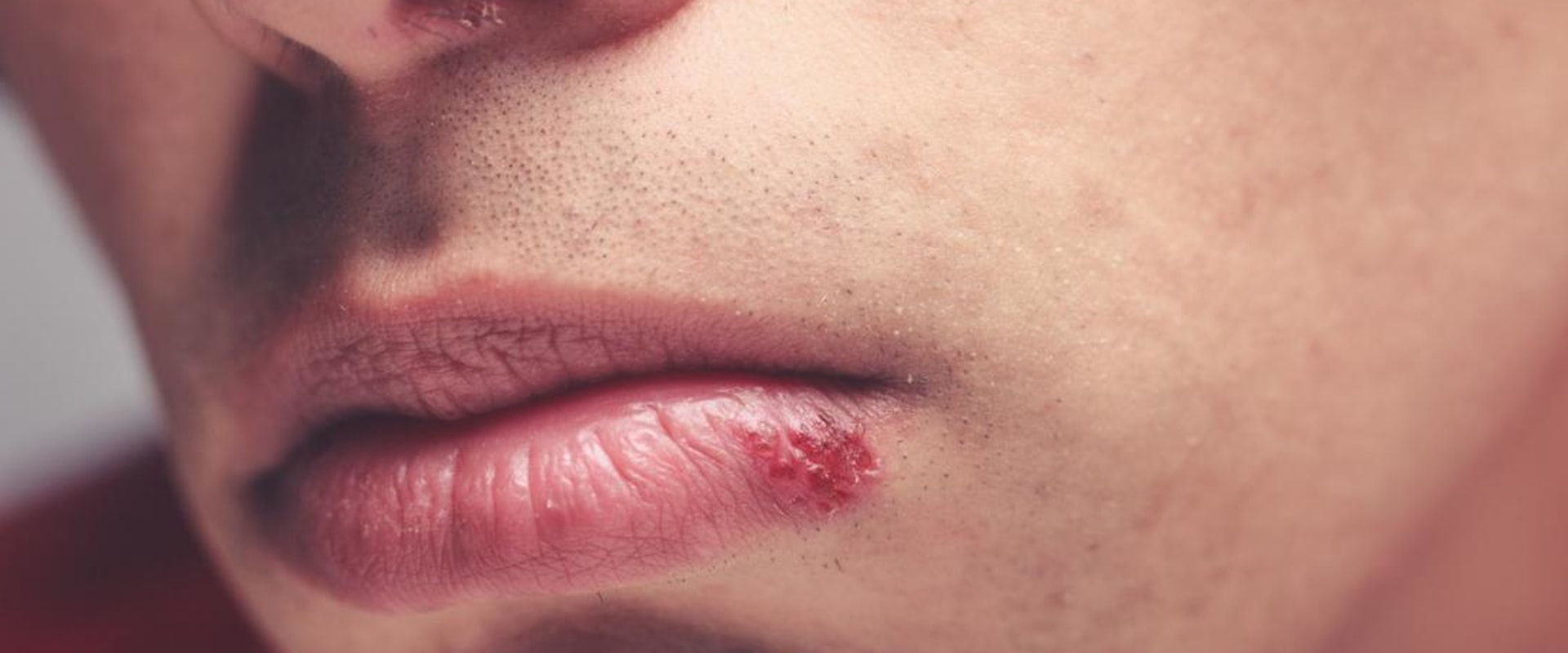 Aromatherapy for Treating Herpes Lips: An Overview