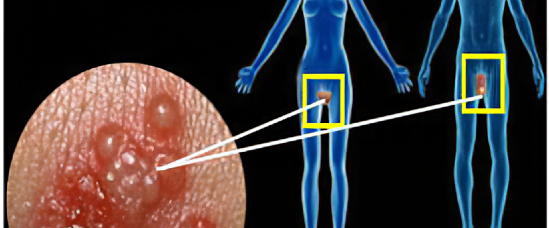 Understanding Herpes Simplex Virus (HSV)