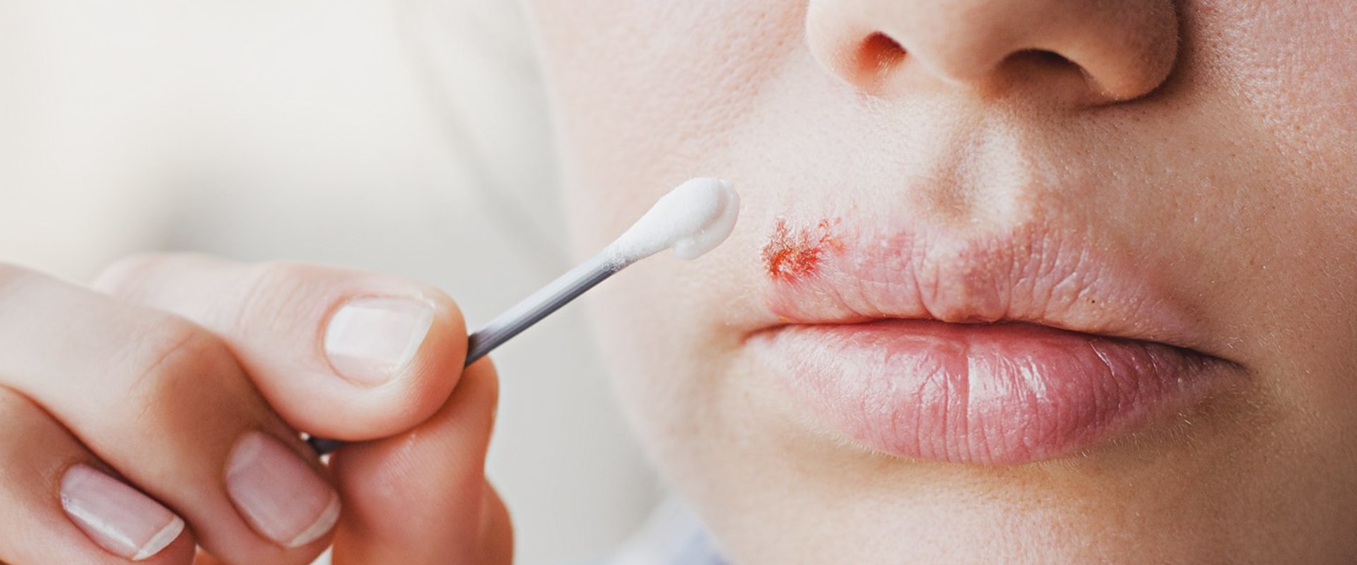 Pain Relievers: An Overview of Over-the-Counter Remedies for Herpes Lips