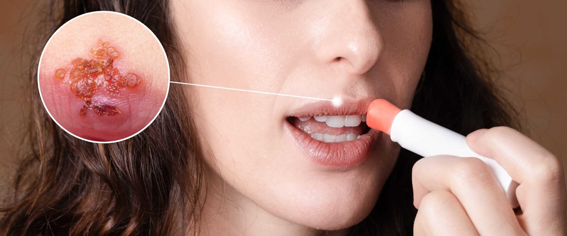 Saltwater Rinses or Gargles: A Home Remedy for Herpes Lips