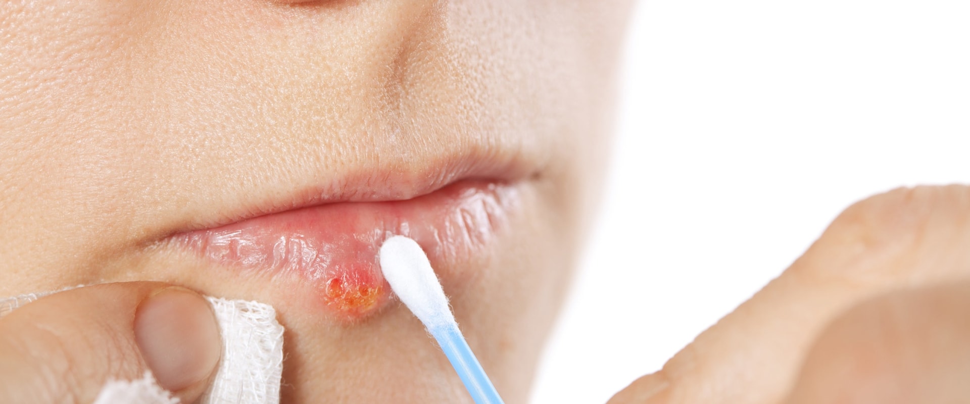 Preventing Herpes Lips Through Avoiding Contact with Infected People and Objects