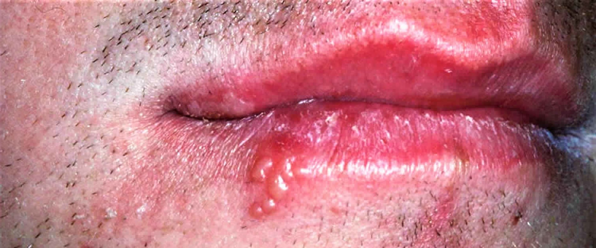 Understanding Corticosteroids: Treatment for Herpes Lips