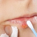 Getting Enough Rest and Exercise: A Home Remedy for Herpes Lips