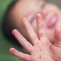 Coxsackievirus: An Overview