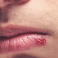 Aromatherapy for Treating Herpes Lips: An Overview