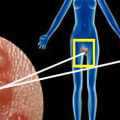 Understanding Herpes Simplex Virus (HSV)