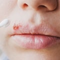 Pain Relievers: An Overview of Over-the-Counter Remedies for Herpes Lips