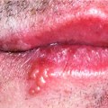 Understanding Corticosteroids: Treatment for Herpes Lips