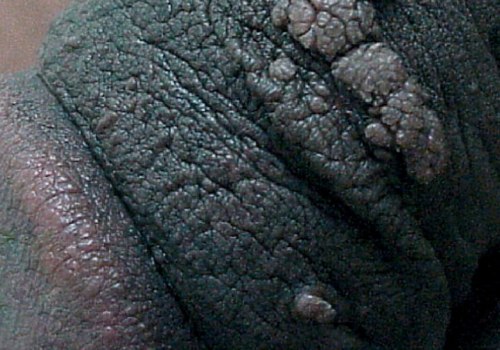 Understanding Human Papillomavirus (HPV)