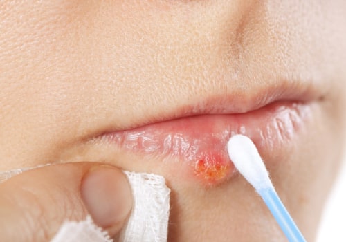 Topical Creams and Ointments: Treatments for Herpes Lips and Over-the-Counter Remedies