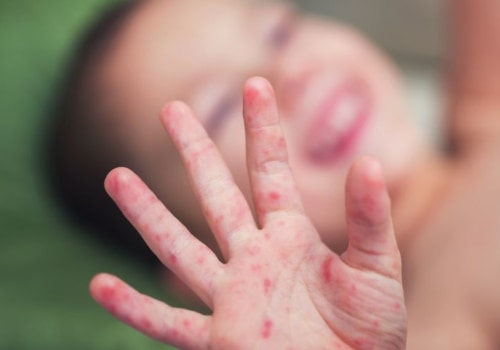Coxsackievirus: An Overview