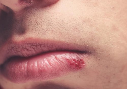 Aromatherapy for Treating Herpes Lips: An Overview