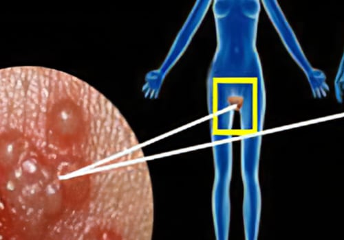 Understanding Herpes Simplex Virus (HSV)