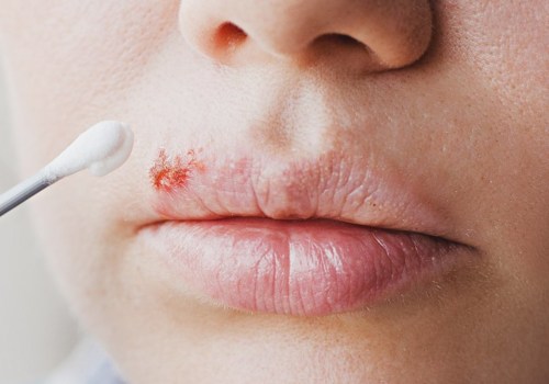Pain Relievers: An Overview of Over-the-Counter Remedies for Herpes Lips