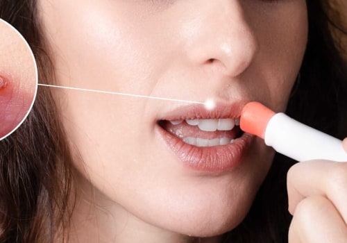 Saltwater Rinses or Gargles: A Home Remedy for Herpes Lips