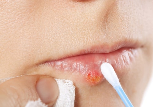 Preventing Herpes Lips Through Avoiding Contact with Infected People and Objects