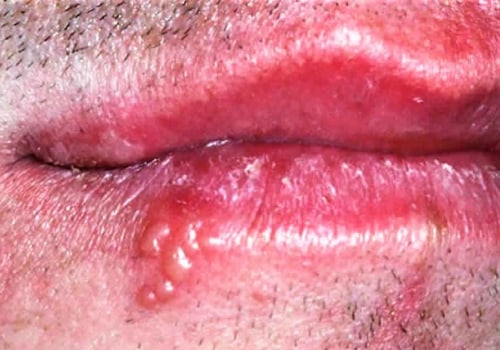 Understanding Corticosteroids: Treatment for Herpes Lips